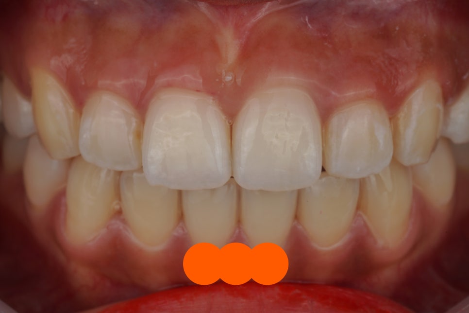 요즘 투스젬 맛집, 근데 이제 제거 맛집인- 투스젬 제거킹 재좋치 관련 이미지 2