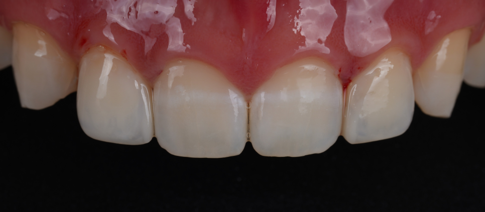 Apgujeong Dental Clinic: 3 Things Needed for Successful Resin Treatment of Peg Laterals image 11