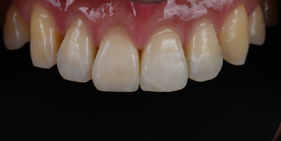 강남역치과 앞니 파절 크라운 말고 레진으로 하세요 관련 이미지 9