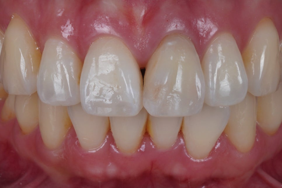 실활치 미백 과정, 크라운 없이 레진으로 마무리 해요 관련 이미지 4