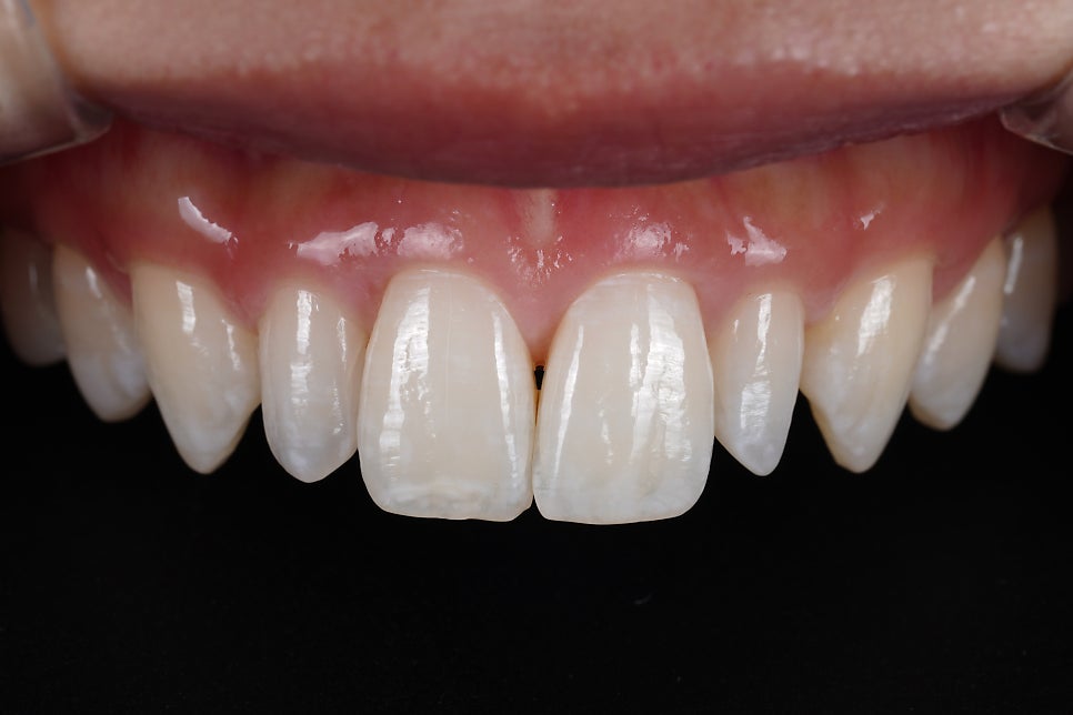 앞니 레진 라미네이트, 1시간 원데이 치료가 가능한 교대 치과 관련 이미지 3