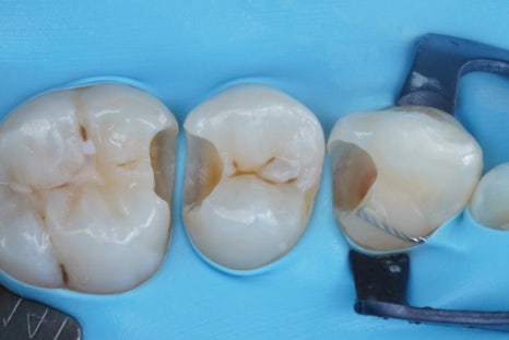 교대역 충치 치과, 신경치료 진단은 보수적으로 접근합니다. 관련 이미지 8