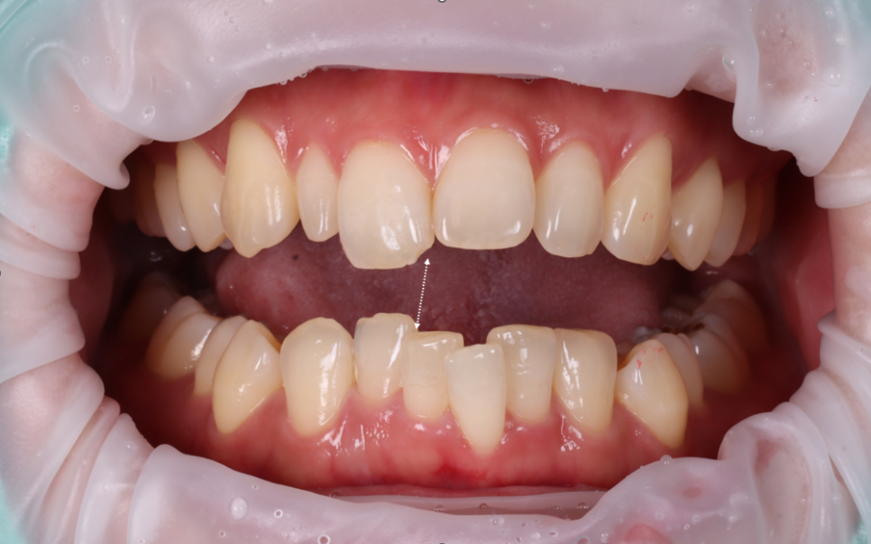 왜소치 레진으로 삭제 없이 예쁘게 관련 이미지 3