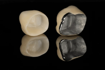 앞니 크라운 검은 선 단순한 보철 문제가 아닐 수도 있습니다 관련 이미지 5