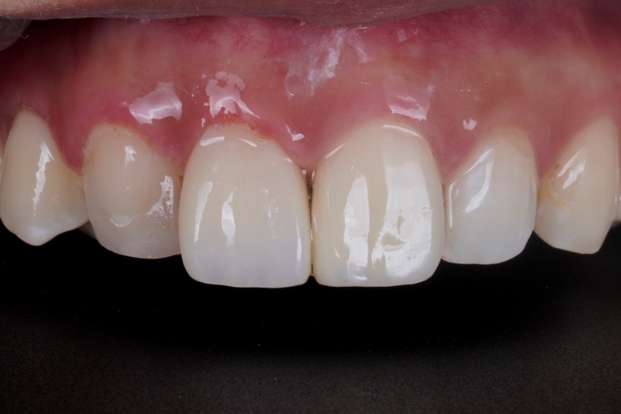 앞니 깨짐 레진 어디서할지 고민될 때 꼭 보세요 관련 이미지 11