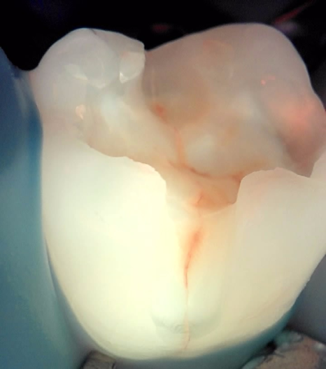 인레이치료 하방 2차 충치 레진 빌드업 사례 관련 이미지 12