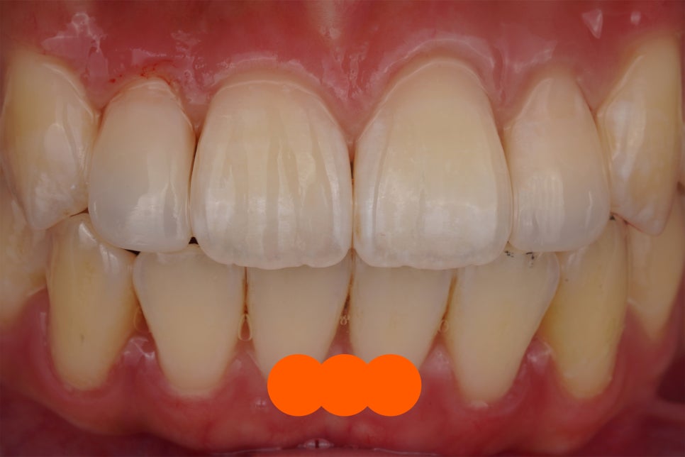 왜소치 레진, 갤럭시네이트 레진비니어로 당일 치료완료 (서초동 치과) 관련 이미지 3