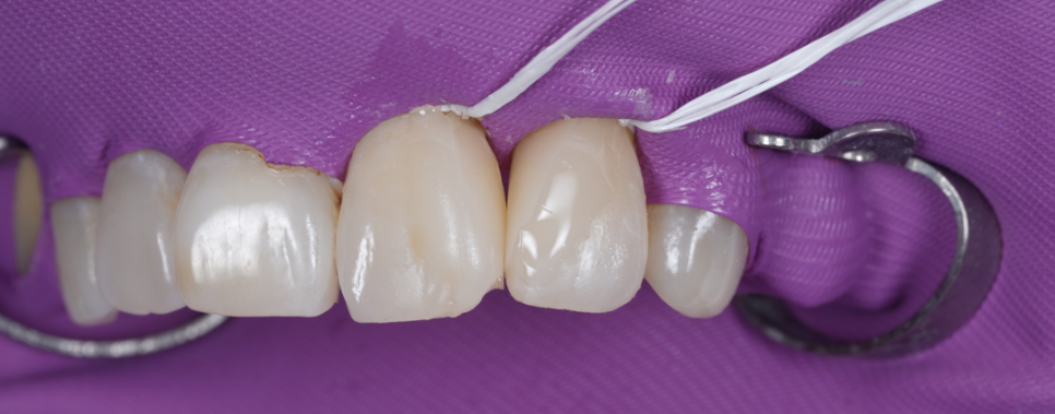 잘못된 앞니 레진 뼈까지 녹인다? 레진 재치료 과정 관련 이미지 13