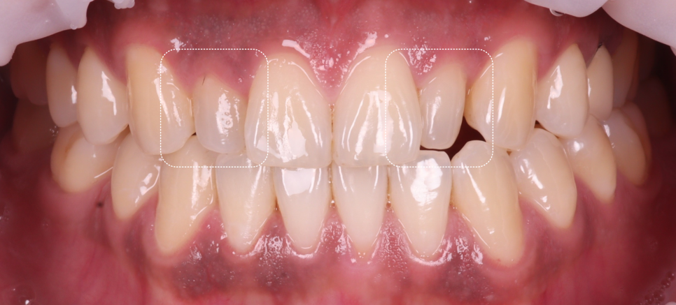 강남역치과 왜소치 레진 비니어로 삭제없이 가지런히 관련 이미지 2