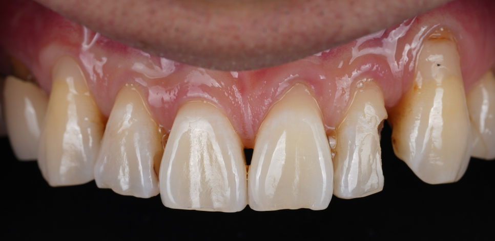 서초구치과 레진 탈락 재치료 2가지가 성공 핵심입니다 관련 이미지 5