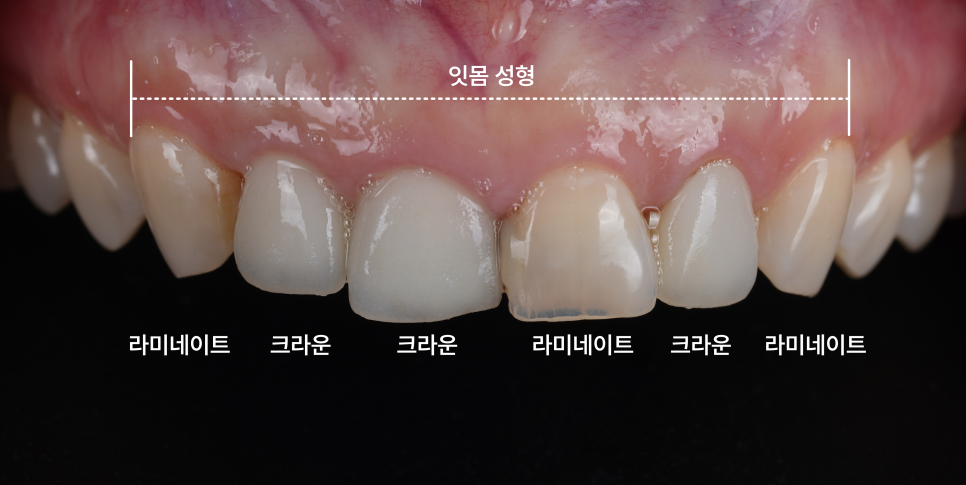 라미네이트, 크라운 재치료, 잇몸 성형까지 앞니 6개 치료 관련 이미지 6