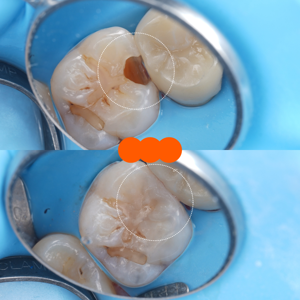 Do Cavities Between Teeth at Sinsa Station Dental Clinic Have to Be Treated with an Inlay? Resin Is Also an Option image 15
