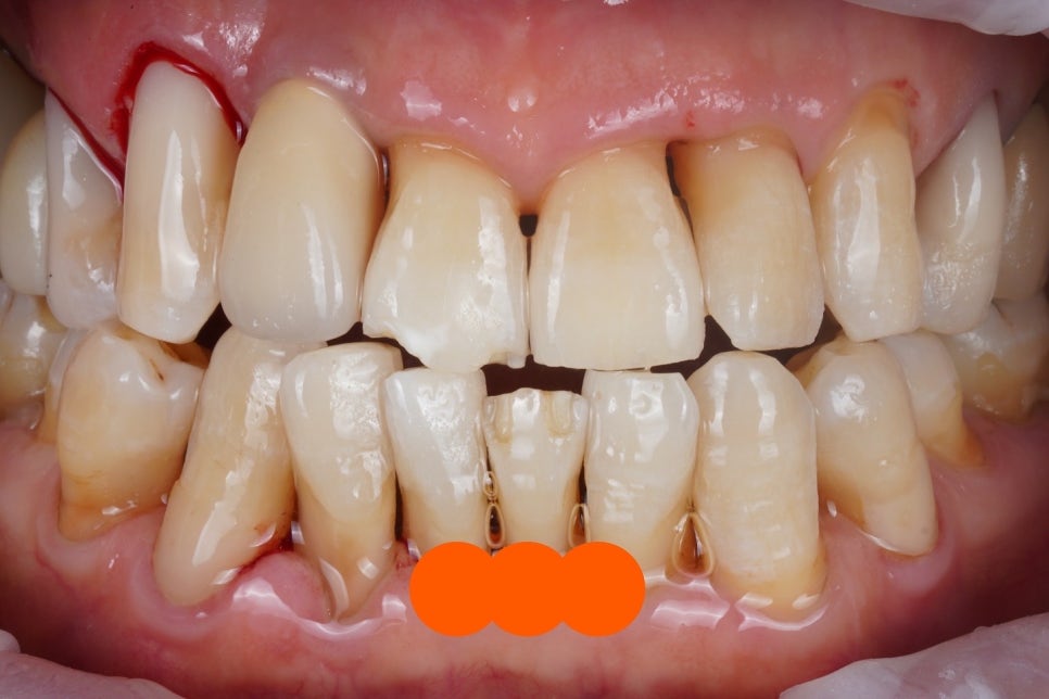 50~60대 잇몸 염증 치료는 주기적인 스케일링부터 시작입니다. 관련 이미지 2