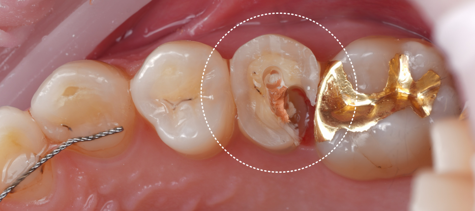 신경치료 후 크라운 안 하고 레진으로 할 수 있어요 관련 이미지 5