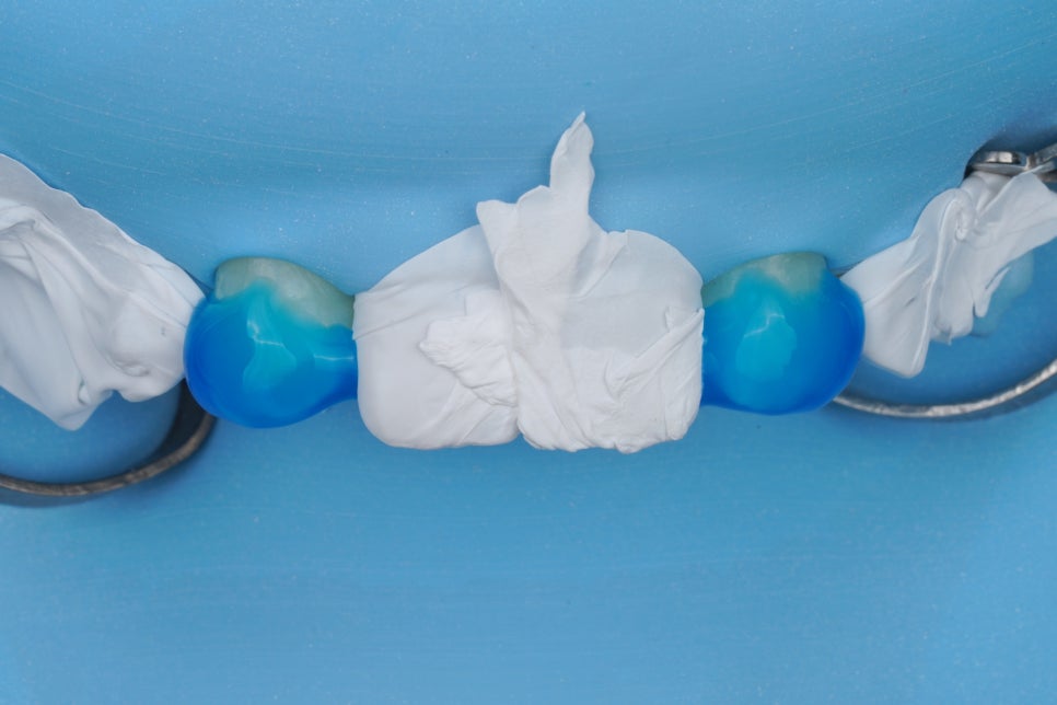 앞니 치료, 왜소치 레진은 교대역 치과에서 당일 치료받으세요 관련 이미지 3