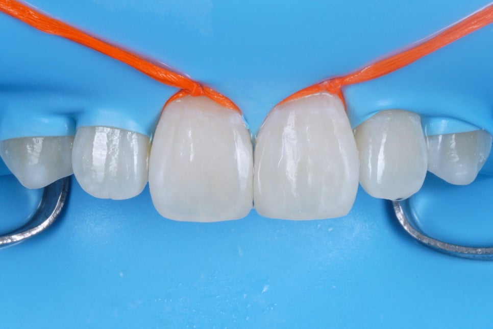 앞니 사이 벌어짐, 레진으로 티 안나게 당일 수복 관련 이미지 3