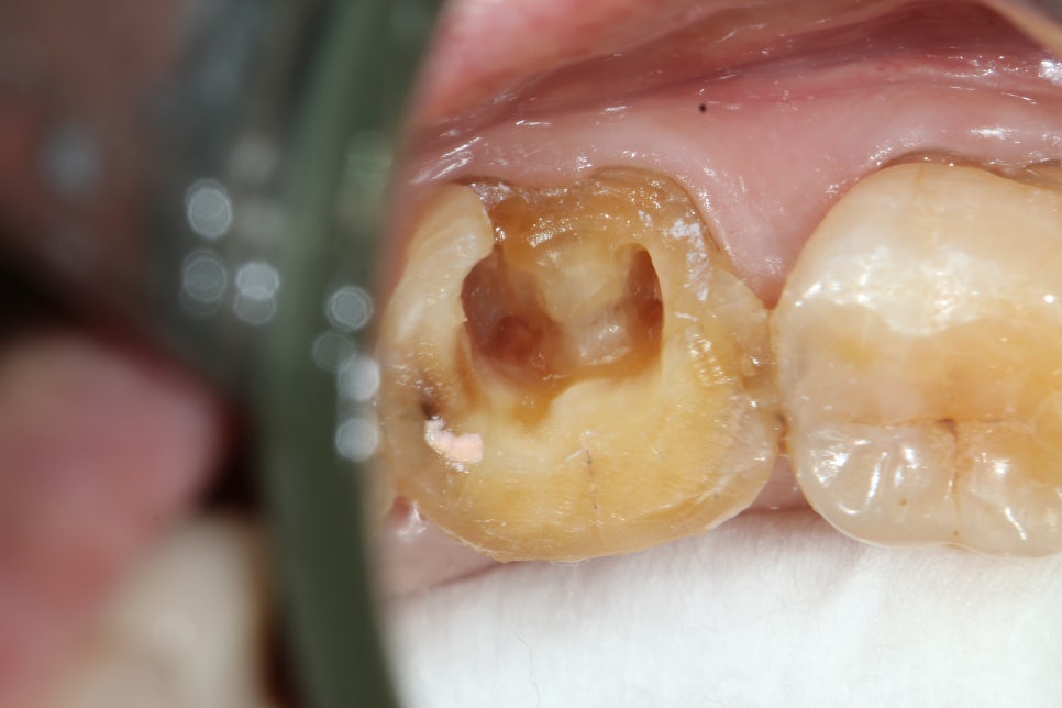 15주차 페닥 일기, 굳은살 관련 이미지 7