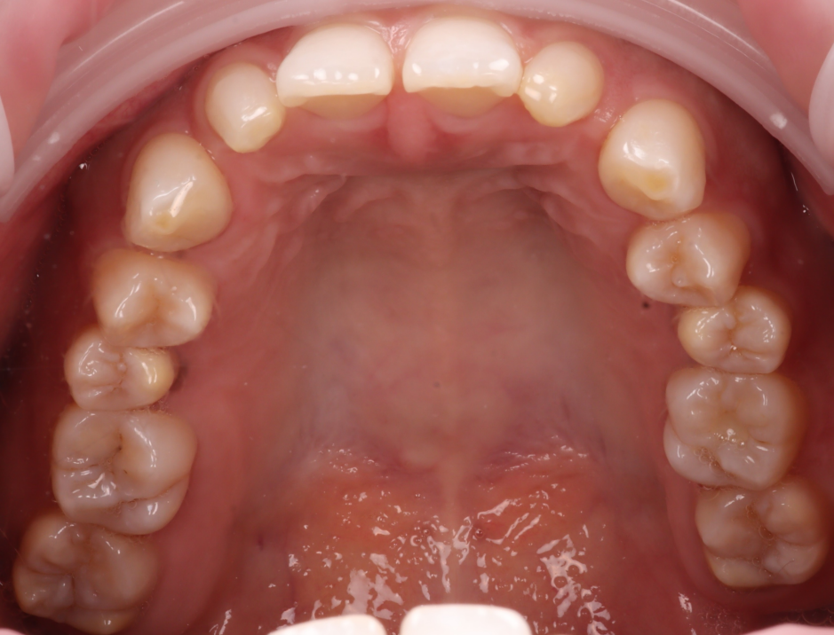 앞니 왜소치 레진 치과의사 소개로 내원해 당일 완료 관련 이미지 5