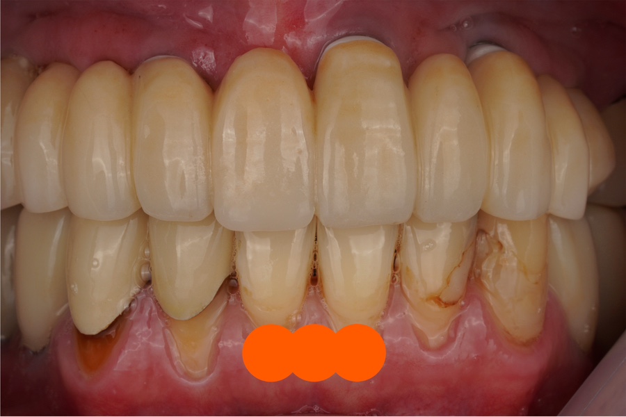 전체임플란트 지르코니아 PFZ 보철 수리해드린 교대역 치과 관련 이미지 2