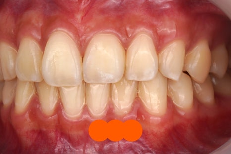 강남역 근처 치과, 투스젬 제거는 여기로 와야합니다 관련 이미지 6