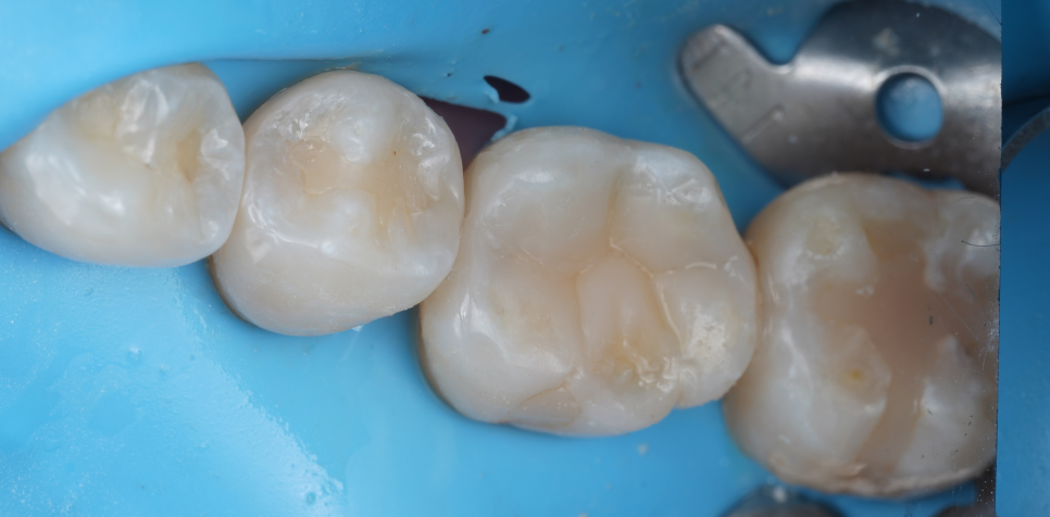 교대역 치과 보철 아래 2차 충치를 다시 레진으로 관련 이미지 26