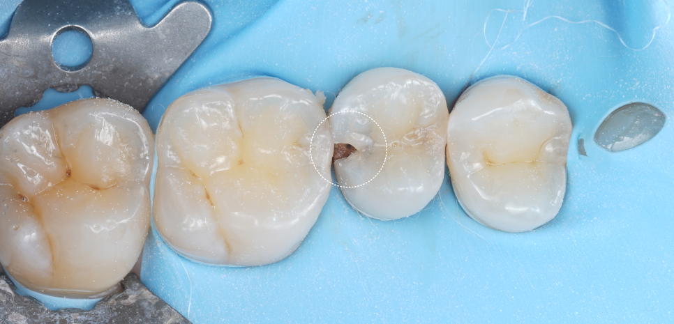 서초역치과 이걸로 신경치료 미뤄드리고 있어요 관련 이미지 7