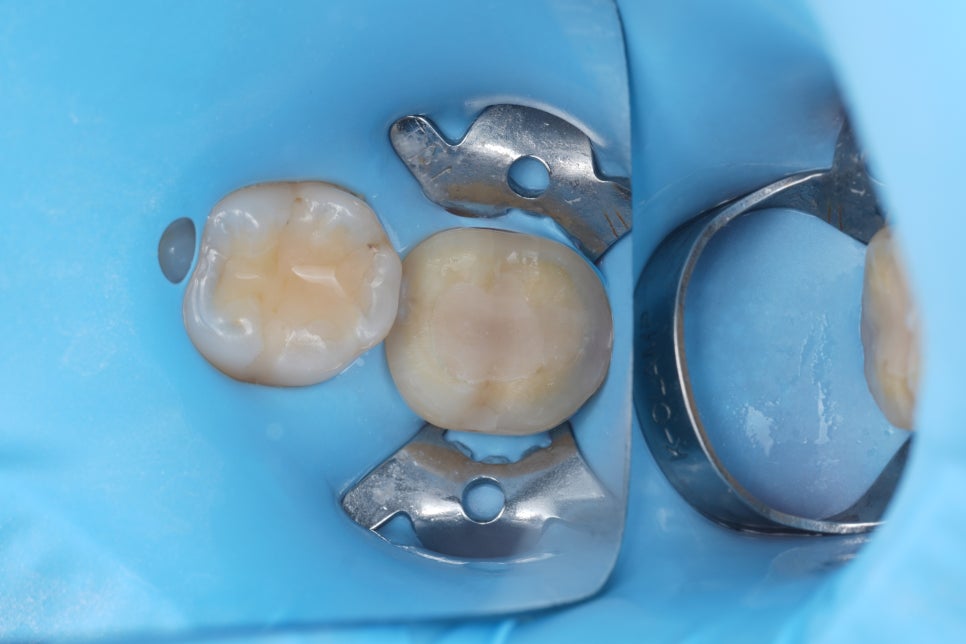 서초동치과 치아 삭제 원하지 않는다면 오버레이 하세요 관련 이미지 9