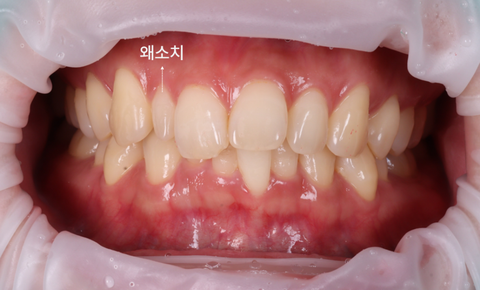 왜소치 라미네이트보다 레진 비니어를 더 추천드리는 이유 관련 이미지 5