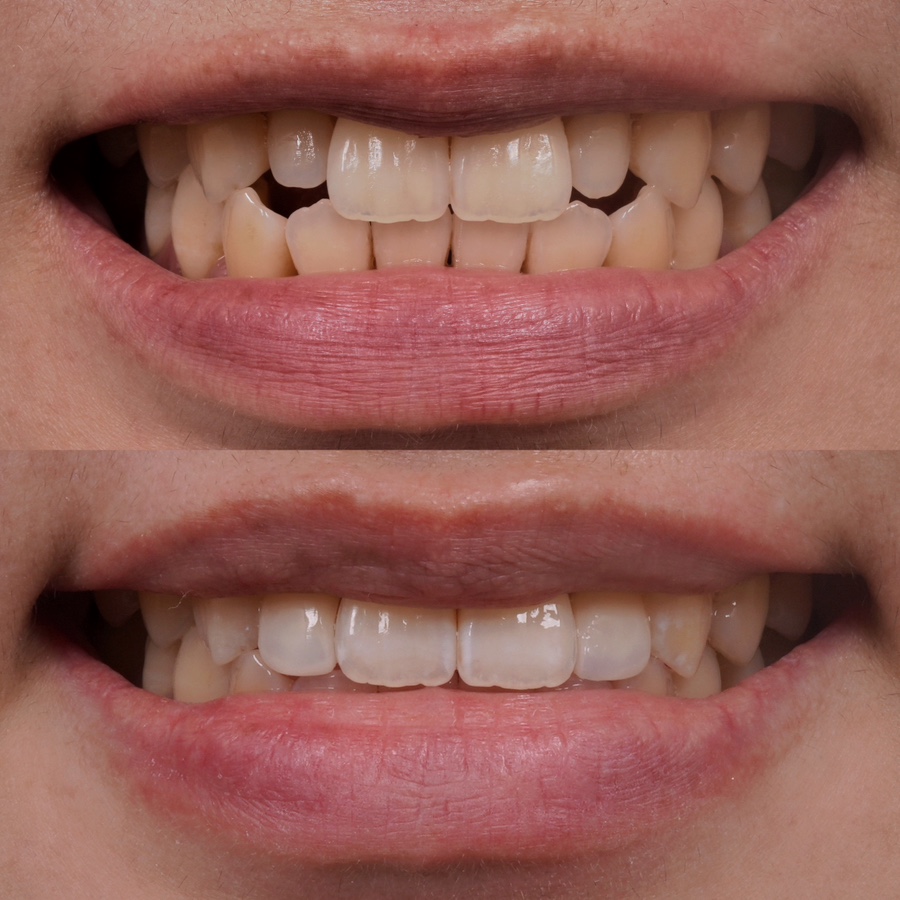 무삭제 라미네이트 잘하는 치과, 중요한 건 치아의 &lsquo;분리감&rsquo; 관련 이미지 1