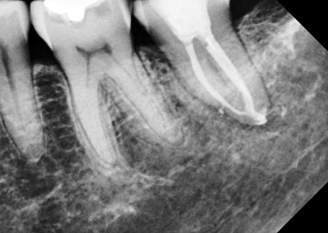 Gangnam Dental Clinic: You Wanted an Extraction, but We Preserved the Tooth with Root Canal Treatment + Overlay image 14