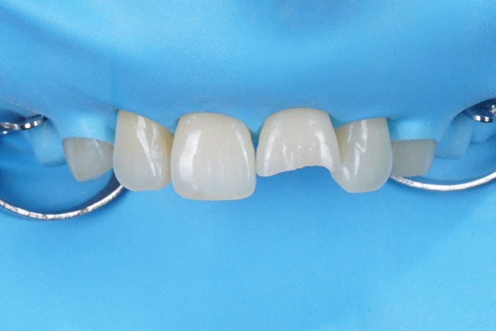 서울 앞니 레진으로 40분 안에 자연스럽게 복원한 케이스 관련 이미지 3