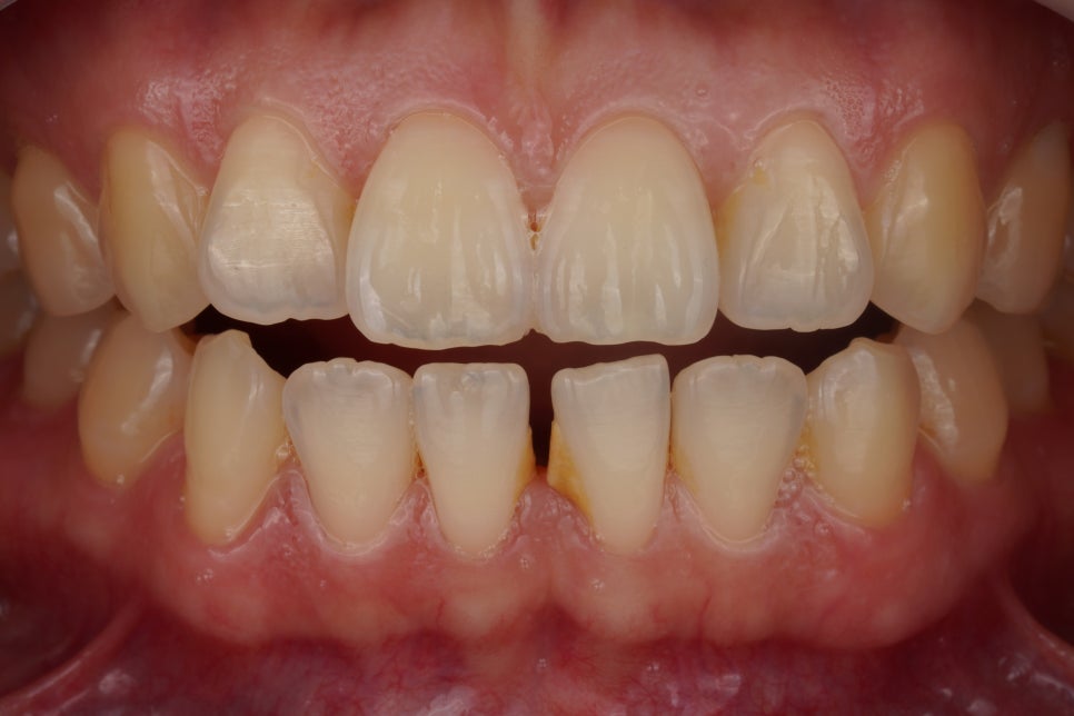 앞니 벌어짐 레진 당일 치료, 앞니 레진 잘하는 서초동 치과 관련 이미지 1