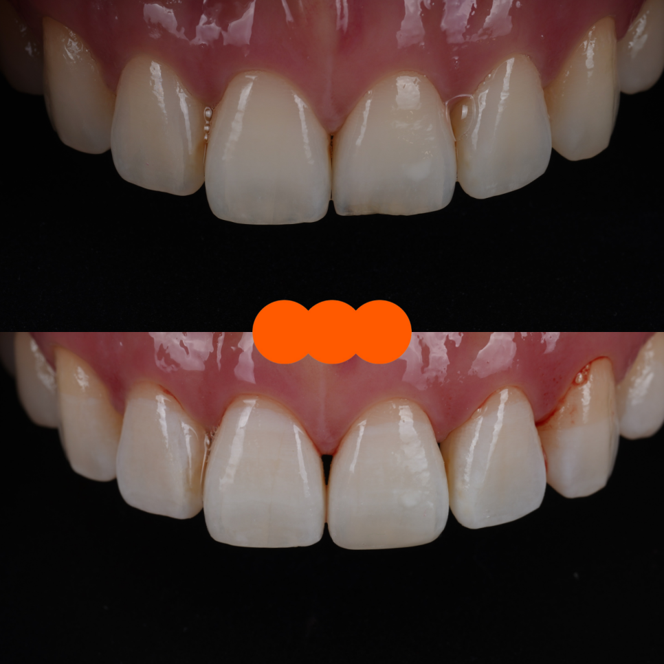 강남치과 짧아 보이는 치아 레진으로 당일 치료 관련 이미지 12