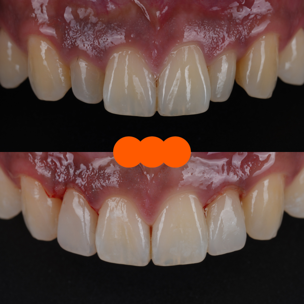 강남역치과 왜소치 레진 비니어로 삭제없이 가지런히 관련 이미지 10