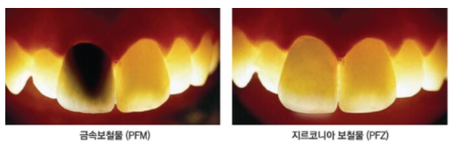 신논현치과 외국인 까만 앞니 크라운 교체 사례 관련 이미지 15
