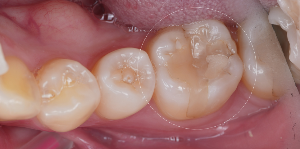 인레이치료 하방 2차 충치 레진 빌드업 사례 관련 이미지 1