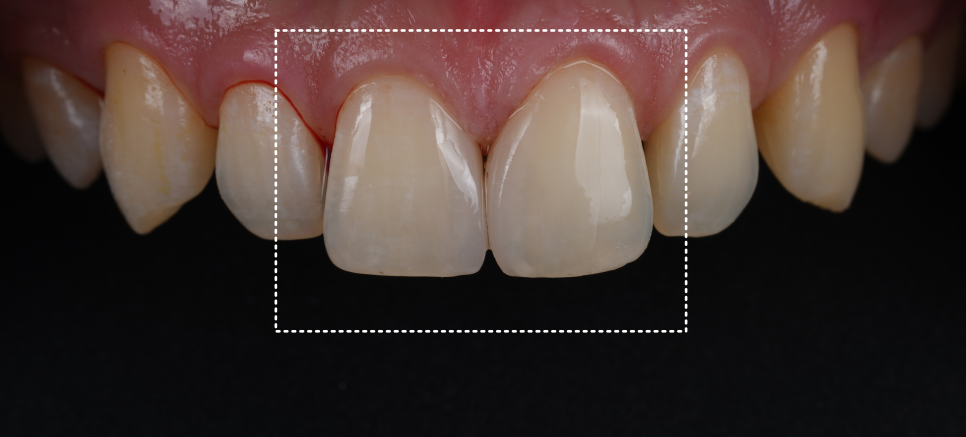 서울치과 앞니 레진 전 이걸 먼저 확인해야 돼요 관련 이미지 9