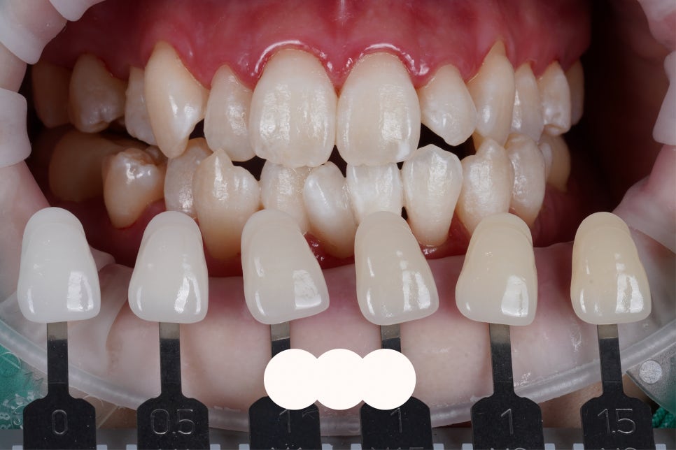 반포동 원데이 치아 미백, 라미네이트 필요 없을지도? 관련 이미지 3
