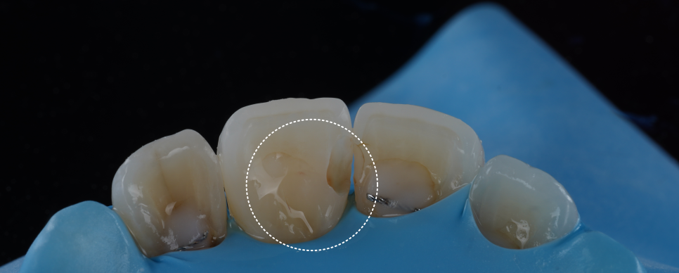 고속터미널역치과 레진치료 처음부터 잘 받아야 하는 이유 관련 이미지 8