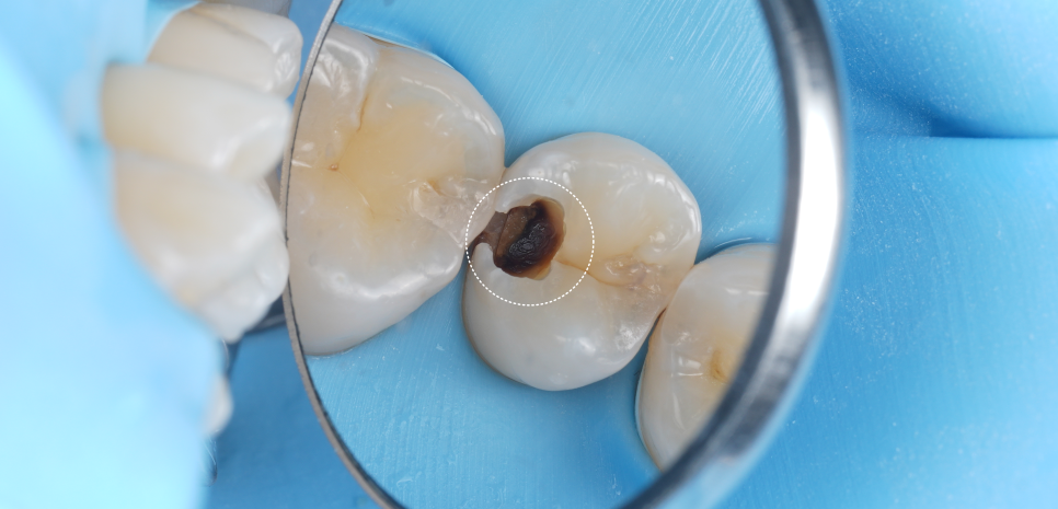 서초역치과 이걸로 신경치료 미뤄드리고 있어요 관련 이미지 8