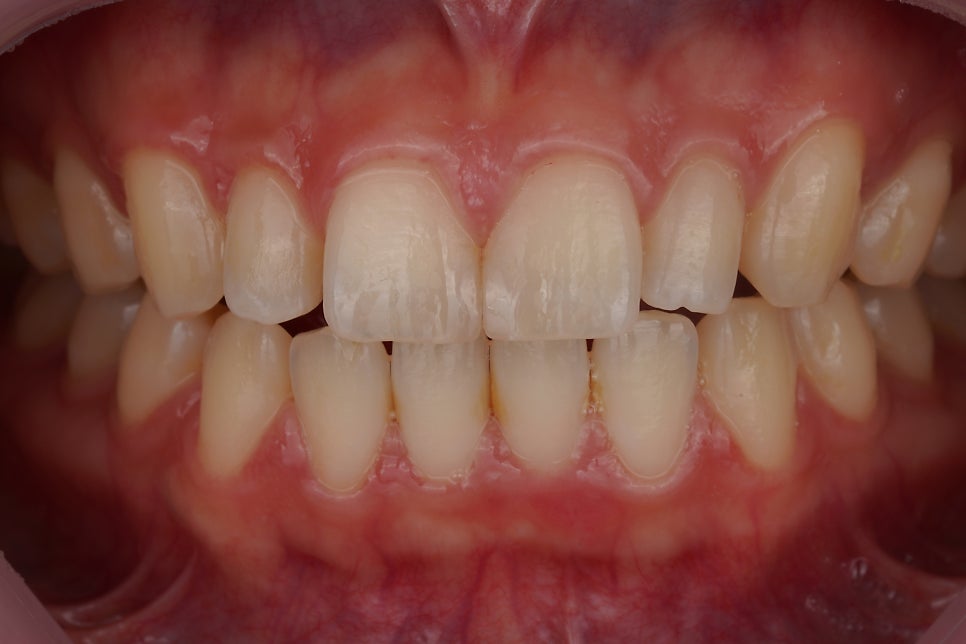 서초/강남 왜소치 레진 비니어, 당일 치료해주는 치과 Direct Composite Veneer in Korea 관련 이미지 2