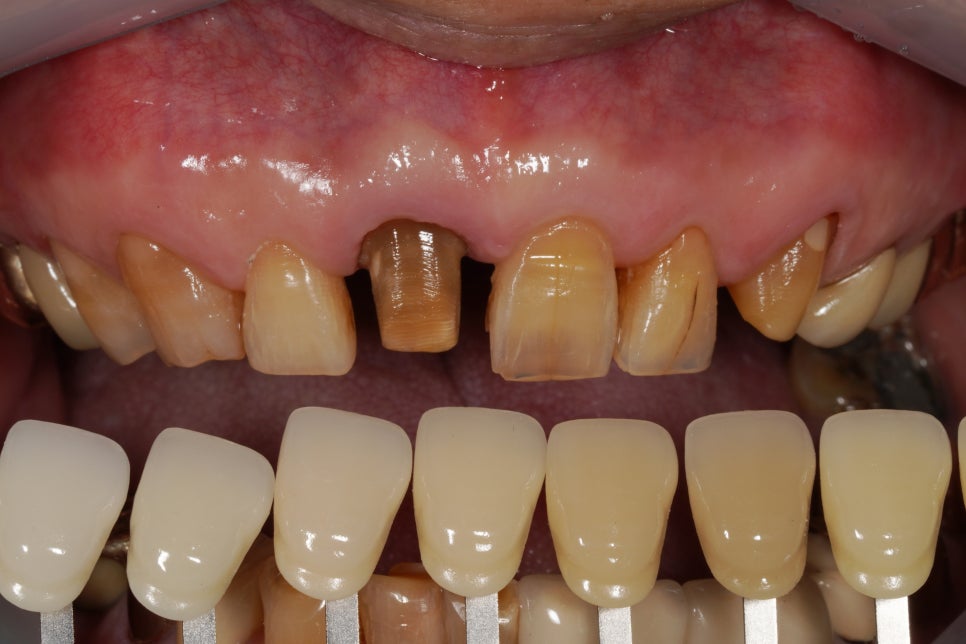 60년 전 신문배달할 때 다쳐서 씌운 앞니 크라운 변색, 지르코니아 재치료 관련 이미지 3