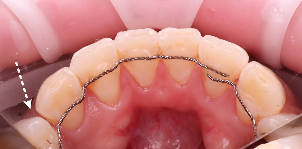 서초구치과 치아 사이 삭제 부작용과 치료법 관련 이미지 7