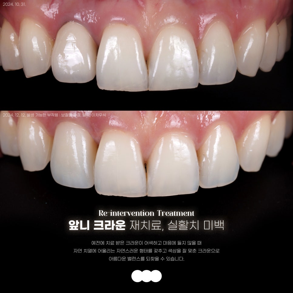 교대역 왜소치 라미네이트, 자연스러운 결과를 위한 고민 관련 이미지 3