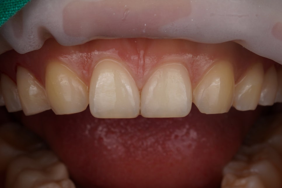 앞니살짝깨짐 치아성형은 역시 교대역 재주좋은 치과 관련 이미지 4