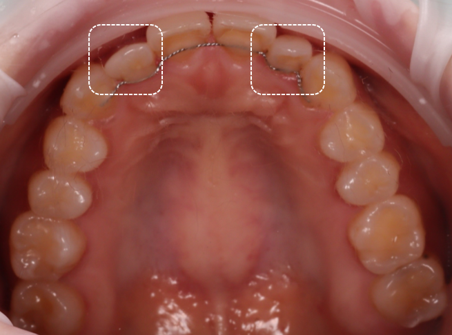 왜소치레진 20년 전에 했던 치아 재치료 후 반대쪽까지 관련 이미지 3