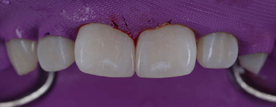 방배동치과 앞니 벌어짐 해결하러 강릉에서 오셨어요 관련 이미지 11