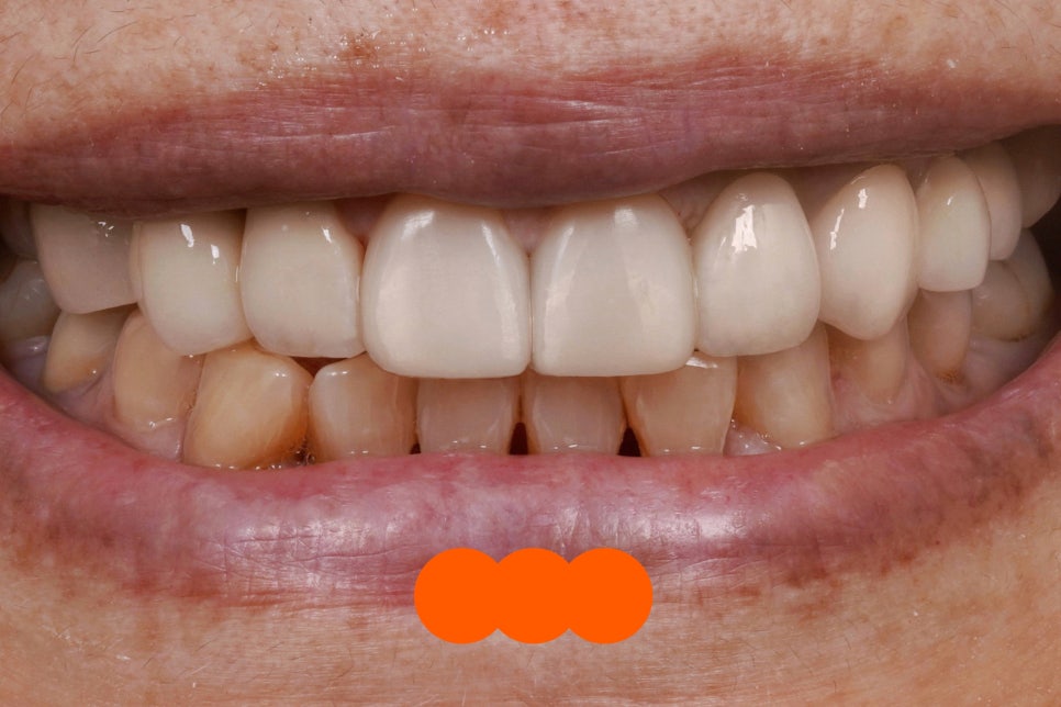 앞니 크라운 재치료 시니어에게 더 중요한 이유 관련 이미지 7