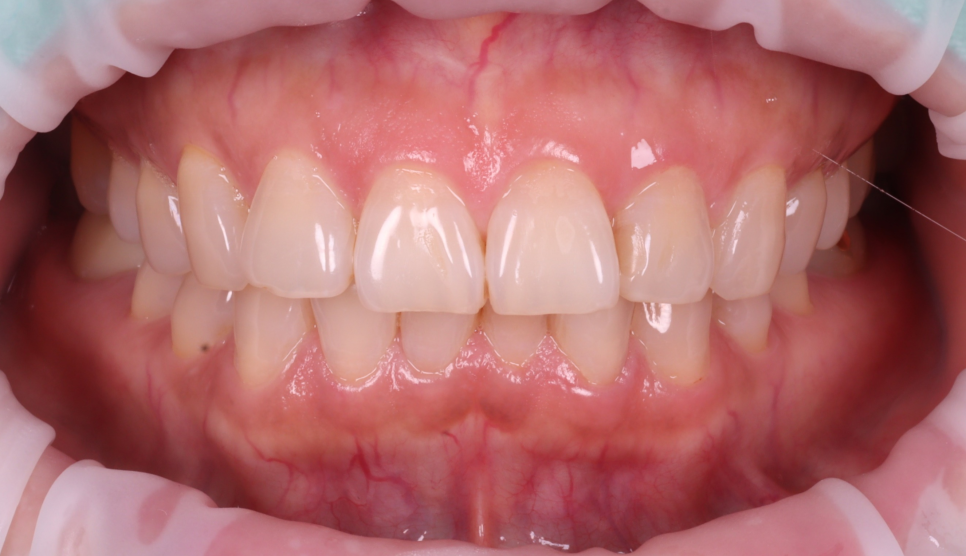 Gangnam Dental Clinic: You Wanted an Extraction, but We Preserved the Tooth with Root Canal Treatment + Overlay image 3