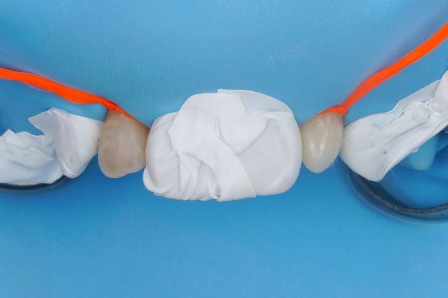 왜소치 레진 라미네이트, 당일 치료 완료! Direct composite veneer하는 서초동 치과 관련 이미지 4